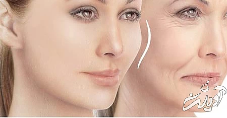 انواع پروتز گونه پروتز گونه, پروتز گونه چیست, انواع پروتز گونه